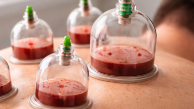  آداب حجامت و توصیه‌های مهم بعد از حجامت+ راهنمای کامل طب سنتی